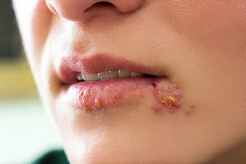 Bệnh xã hội phổ biến nhất khi quan hệ bằng miệng là herpes